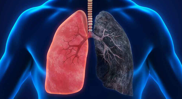 Biologia: Pulmão de fumante – Como é? Existem maneiras de amenizar o problema?